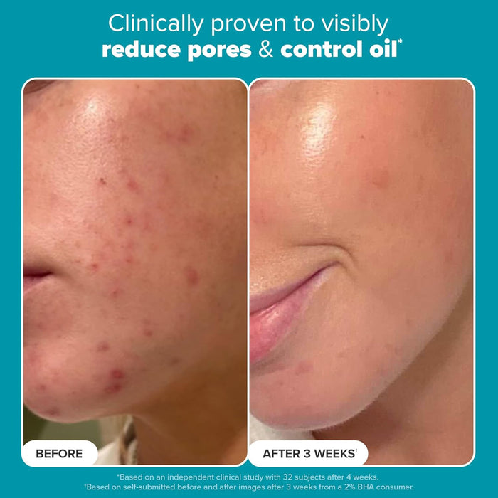 Paula's Choice SKIN PERFECTING 2% BHA Liquid Exfoliant with Salicylic Acid, Facial Polish for Enlarged Pores, Wrinkles & Fine Lines, Suitable for Blackhead-Prone Skin, Fragrance-Free